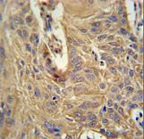 IL5RA / CD125 Antibody - IL5RA Antibody immunohistochemistry of formalin-fixed and paraffin-embedded human lung carcinoma followed by peroxidase-conjugated secondary antibody and DAB staining.
