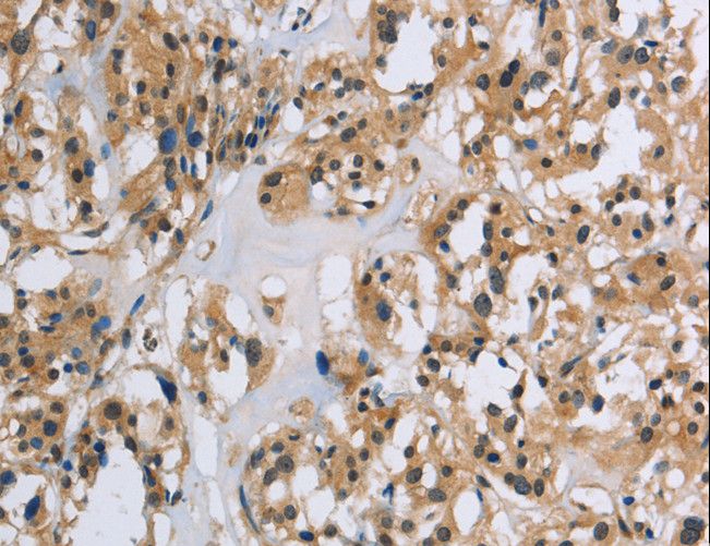 IL5RA / CD125 Antibody - Immunohistochemistry of paraffin-embedded Human thyroid cancer using IL5RA Polyclonal Antibody at dilution of 1:40.