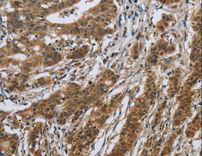 IL5RA / CD125 Antibody - Immunohistochemistry of paraffin-embedded Human gastric cancer using IL5RA Polyclonal Antibody at dilution of 1:40.
