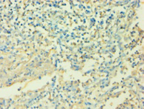 IL6 / Interleukin 6 Antibody - Immunohistochemistry of paraffin-embedded human cervical cancer using IL6 Antibody at dilution of 1:100