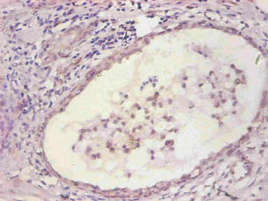 IL6 / Interleukin 6 Antibody - Immunohistochemical of paraffin-embedded human prostate tissue using IL6 Monoclonal Antibody at dilution of 1:200