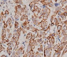 IL6 / Interleukin 6 Antibody - 1:200 staining human breast carcinoma tissue by IHC-P. The tissue was formaldehyde fixed and a heat mediated antigen retrieval step in citrate buffer was performed. The tissue was then blocked and incubated with the antibody for 1.5 hours at 22°C. An HRP conjugated goat anti-rabbit antibody was used as the secondary.