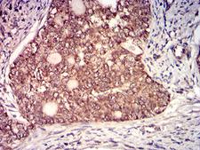 IL6ST / CD130 / gp130 Antibody - Immunohistochemical analysis of paraffin-embedded cervical cancer tissues using CD130 mouse mAb with DAB staining.