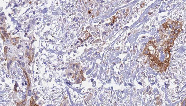 IL6ST / CD130 / gp130 Antibody - 1:100 staining human urothelial carcinoma tissue by IHC-P. The sample was formaldehyde fixed and a heat mediated antigen retrieval step in citrate buffer was performed. The sample was then blocked and incubated with the antibody for 1.5 hours at 22°C. An HRP conjugated goat anti-rabbit antibody was used as the secondary.