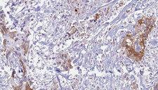 IL6ST / CD130 / gp130 Antibody - 1:100 staining human urothelial carcinoma tissue by IHC-P. The sample was formaldehyde fixed and a heat mediated antigen retrieval step in citrate buffer was performed. The sample was then blocked and incubated with the antibody for 1.5 hours at 22°C. An HRP conjugated goat anti-rabbit antibody was used as the secondary.