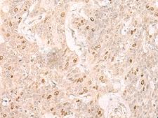 IL7 Antibody - Immunohistochemistry of paraffin-embedded Human esophagus cancer tissue  using IL7 Polyclonal Antibody at dilution of 1:30(×200)