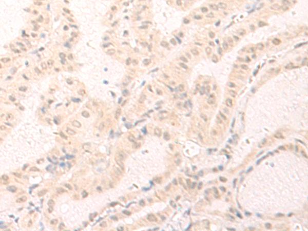 IL7 Antibody - Immunohistochemistry of paraffin-embedded Human thyroid cancer tissue  using IL7 Polyclonal Antibody at dilution of 1:30(×200)