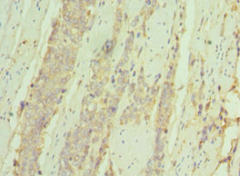 IL7R / CD127 Antibody - Immunohistochemistry of paraffin-embedded human colon cancer using IL7R Antibody at dilution of 1:100