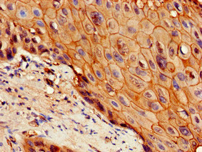 IL7R / CD127 Antibody - Immunohistochemistry of paraffin-embedded human cervical cancer at dilution of 1:100