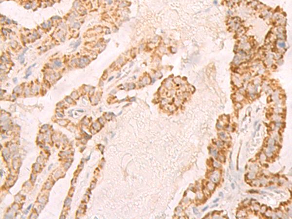 IL7R / CD127 Antibody - Immunohistochemistry of paraffin-embedded Human thyroid cancer tissue  using IL7R Polyclonal Antibody at dilution of 1:45(×200)