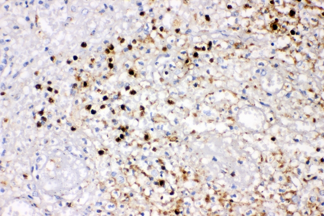 IL8 / Interleukin 8 Antibody - IHC analysis of IL-8 using anti-IL-8 antibody. IL-8 was detected in paraffin-embedded section of human appendicitis tissues. Heat mediated antigen retrieval was performed in citrate buffer (pH6, epitope retrieval solution) for 20 mins. The tissue section was blocked with 10% goat serum. The tissue section was then incubated with 1µg/ml rabbit anti-IL-8 Antibody overnight at 4°C. Biotinylated goat anti-rabbit IgG was used as secondary antibody and incubated for 30 minutes at 37°C. The tissue section was developed using Strepavidin-Biotin-Complex (SABC) with DAB as the chromogen.