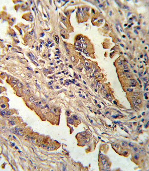 IL8 / Interleukin 8 Antibody - Formalin-fixed and paraffin-embedded human lung carcinoma reacted with IL8 Antibody , which was peroxidase-conjugated to the secondary antibody, followed by DAB staining. This data demonstrates the use of this antibody for immunohistochemistry; clinical relevance has not been evaluated.