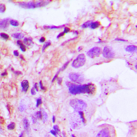 IL8 / Interleukin 8 Antibody - Immunohistochemical analysis of IL-8 staining in human lung cancer formalin fixed paraffin embedded tissue section. The section was pre-treated using heat mediated antigen retrieval with sodium citrate buffer (pH 6.0). The section was then incubated with the antibody at room temperature and detected using an HRP conjugated compact polymer system. DAB was used as the chromogen. The section was then counterstained with hematoxylin and mounted with DPX.