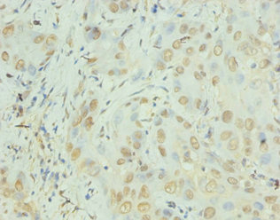 IL8 / Interleukin 8 Antibody - Immunohistochemistry of paraffin-embedded human liver cancer using CXCL8 Antibody at dilution of 1:100