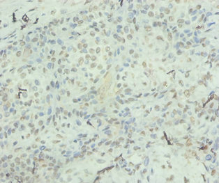 IL8 / Interleukin 8 Antibody - Immunohistochemistry of paraffin-embedded human mammary carinoma tissue using CXCL8 Antibody at dilution of 1:100