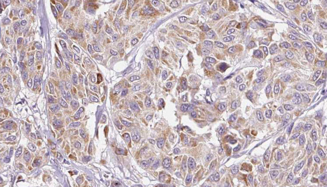 IL8 / Interleukin 8 Antibody - 1:100 staining human Melanoma tissue by IHC-P. The sample was formaldehyde fixed and a heat mediated antigen retrieval step in citrate buffer was performed. The sample was then blocked and incubated with the antibody for 1.5 hours at 22°C. An HRP conjugated goat anti-rabbit antibody was used as the secondary.