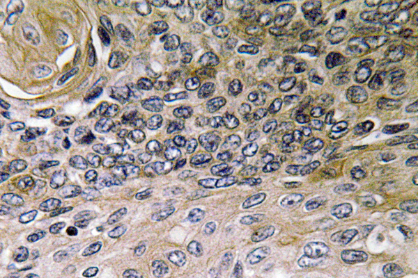 IL8 / Interleukin 8 Antibody - IHC of IL-8 (V68) pAb in paraffin-embedded human lung carcinoma tissue.