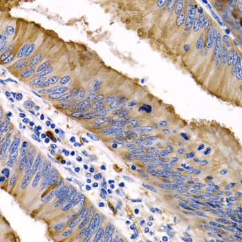 IL9 Antibody - Immunohistochemistry of paraffin-embedded human colon cancer tissue.