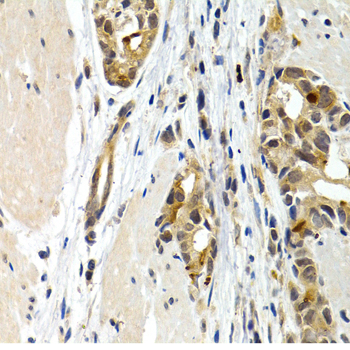 IL9 Antibody - Immunohistochemistry of paraffin-embedded human stomach cancer tissue.