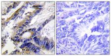 ILKAP Antibody - Immunohistochemistry analysis of paraffin-embedded human colon carcinoma tissue, using ILKAP Antibody. The picture on the right is blocked with the synthesized peptide.