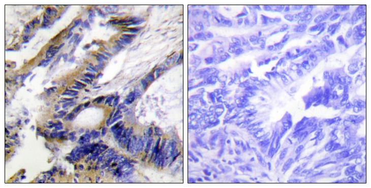 ILKAP Antibody - Peptide - + Immunohistochemistry analysis of paraffin-embedded human colon carcinoma tissue using ILKAP antibody.