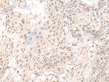 ILKAP Antibody - Immunohistochemistry of paraffin-embedded Human esophagus cancer tissue  using ILKAP Polyclonal Antibody at dilution of 1:50(×200)