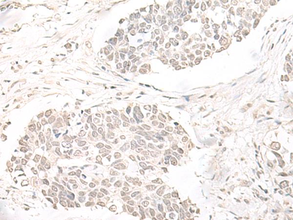 ILKAP Antibody - Immunohistochemistry of paraffin-embedded Human lung cancer tissue  using ILKAP Polyclonal Antibody at dilution of 1:50(×200)