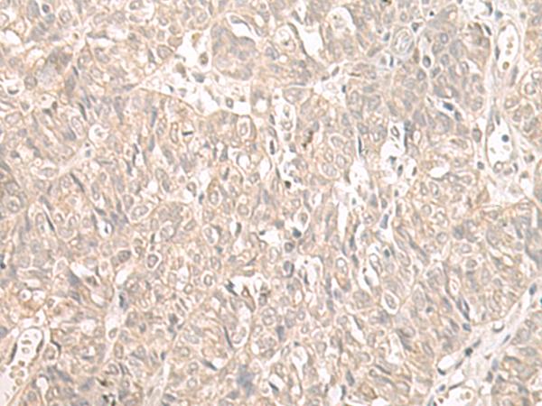 ILKAP Antibody - Immunohistochemistry of paraffin-embedded Human ovarian cancer tissue  using ILKAP Polyclonal Antibody at dilution of 1:55(×200)