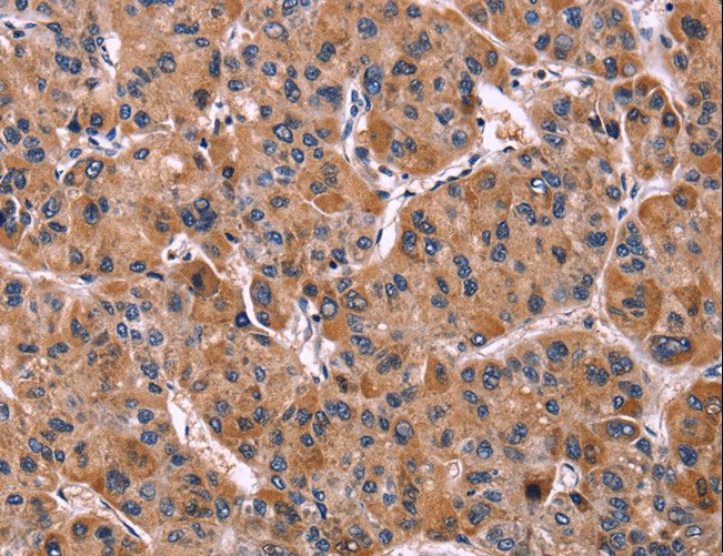 ILT2 / CD85 Antibody - Immunohistochemistry of paraffin-embedded Human liver cancer using LILRB1 Polyclonal Antibody at dilution of 1:50.