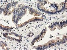 ILVBL Antibody - IHC of paraffin-embedded Adenocarcinoma of Human colon tissue using anti-ILVBL mouse monoclonal antibody. (Heat-induced epitope retrieval by 10mM citric buffer, pH6.0, 100C for 10min).
