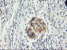 ILVBL Antibody - IHC of paraffin-embedded Carcinoma of Human pancreas tissue using anti-ILVBL mouse monoclonal antibody. (Heat-induced epitope retrieval by 10mM citric buffer, pH6.0, 100C for 10min).