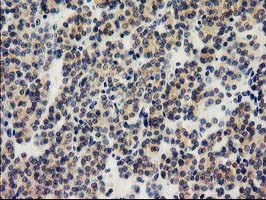 ILVBL Antibody - IHC of paraffin-embedded Carcinoma of Human thyroid tissue using anti-ILVBL mouse monoclonal antibody. (Heat-induced epitope retrieval by 10mM citric buffer, pH6.0, 100C for 10min).