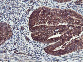 ILVBL Antibody - IHC of paraffin-embedded Adenocarcinoma of Human endometrium tissue using anti-ILVBL mouse monoclonal antibody.