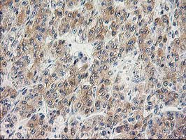 ILVBL Antibody - IHC of paraffin-embedded Carcinoma of Human liver tissue using anti-ILVBL mouse monoclonal antibody.