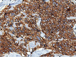 ILVBL Antibody - IHC of paraffin-embedded Adenocarcinoma of Human breast tissue using anti-ILVBL mouse monoclonal antibody.