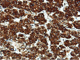 ILVBL Antibody - IHC of paraffin-embedded Carcinoma of Human liver tissue using anti-ILVBL mouse monoclonal antibody.