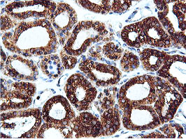ILVBL Antibody - IHC of paraffin-embedded Carcinoma of Human thyroid tissue using anti-ILVBL mouse monoclonal antibody.