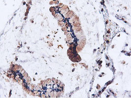 ILVBL Antibody - IHC of paraffin-embedded Adenocarcinoma of Human colon tissue using anti-ILVBL mouse monoclonal antibody.