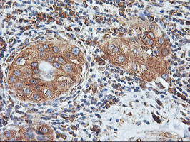 ILVBL Antibody - IHC of paraffin-embedded Carcinoma of Human bladder tissue using anti-ILVBL mouse monoclonal antibody.