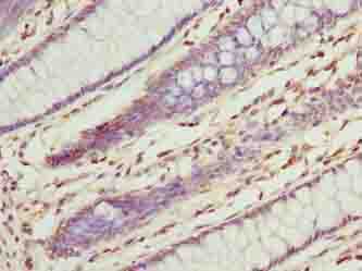 ILVBL Antibody - Immunohistochemistry of paraffin-embedded human colon cancer using antibody at dilution of 1:100.