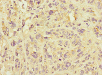 IMMP2L Antibody - Immunohistochemistry of paraffin-embedded human melanoma at dilution 1:100