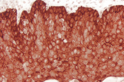 Product - Tonsil: Cytokeratin (AE1/AE3 (m), ImmPRESS™ Reagent (HRP), ImmPACT™ NovaRED® Substrate (red).