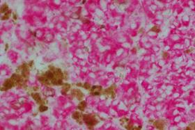 Product - Melanoma was stained with anti-vimentin followed by ImmPRESS™-AP Anti-Rabbit IgG Reagent and Vector Red™ Substrate. Note the excellent contrast of the substrate with the brown pigments.