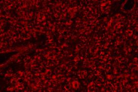 Product - Melanoma was stained with anti-vimentin followed by ImmPRESS™-AP Anti-Rabbit IgG Reagent and Vector Red™ Substrate. Viewed under fluorescence microscopy.