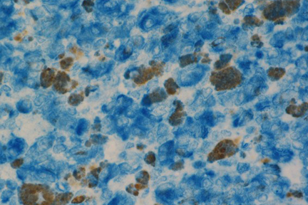 Product - Melanoma: Anti-Vimentin (rabbit mab), ImmPRESS-AP Anti-Rabbit IgG, Vector Blue™ Substrate (blue).