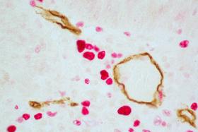 Product - Colon Carcinoma (paraffin): ImmPRESS™ Duet Kit (LS-J1072) used to detect mouse anti-CD34 (ImmPACT™ DAB, brown) and rabbit anti-Ki67 (ImmPACT™ Vector® Red, magenta) antibodies.