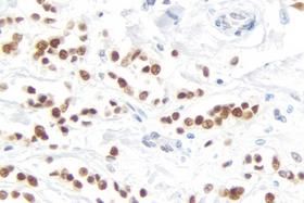 Product - Breast Carcinoma: Progesterone Receptor (rm), ImmPRESS™ Universal Antibody Kit, DAB Substrate Kit (brown). Hematoxylin QS counterstain (blue).