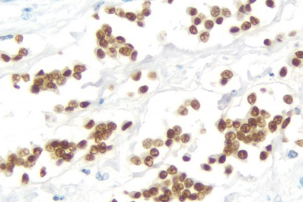 Product - Breast Carcinoma: Estrogen Receptor (rm), ImmPRESS™ Universal Antibody Kit, DAB substrate Kit (brown). Hematoxylin QS counterstain (blue).