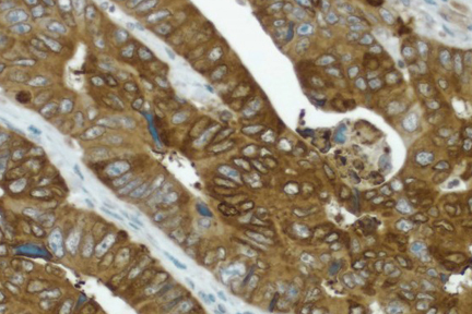Product - Colon cancer: COX-2 rabbit monoclonal antibody detected with ImmPRESS™ Universal Reagent and DAB substrate (brown). Hematoxylin QS counterstain (blue). Formalin-fixed, paraffin embedded tissue section.