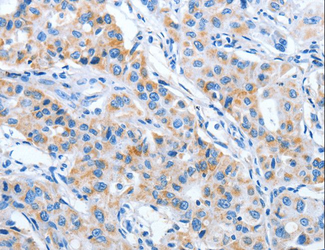 IMMT / Mitofilin Antibody - Immunohistochemistry of paraffin-embedded Human lung cancer using IMMT Polyclonal Antibody at dilution of 1:70.